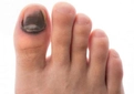 Ayak Baş Parmak Morarması Belirtileri ve Tedavisi Ayak Baş Parmak Morarması Belirtileri ve Tedavisi