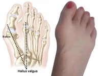 Ayak Baş Parmak Kireçlenmesi Belirtileri ve Tedavisi Ayak Baş Parmak Kireçlenmesi Belirtileri ve Tedavisi