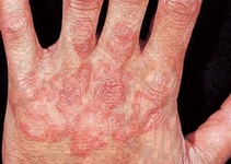 El Parmak Mantarı Belirtileri ve Tedavisi El Parmak Mantarı Belirtileri ve Tedavisi