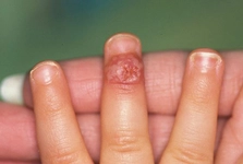 Parmakta Dolama Belirtileri ve Tedavisi Parmakta Dolama Belirtileri ve Tedavisi